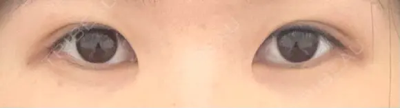 二重切開 松下皮フ形成外科 DAY 11 メイン用