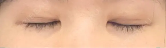 二重切開 松下皮フ形成外科 DAY 11 メイン用