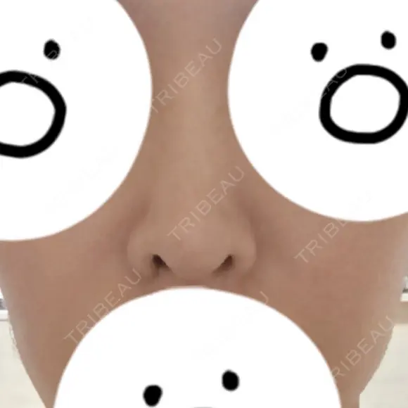 隆鼻術 / 鼻中隔延長（切開） / 小鼻縮小（切開） / 軟骨移植 / 鼻修正 / 鼻孔縁下降 FROM B整形外科 (旧バウム整形外科) DAY 28 メイン用