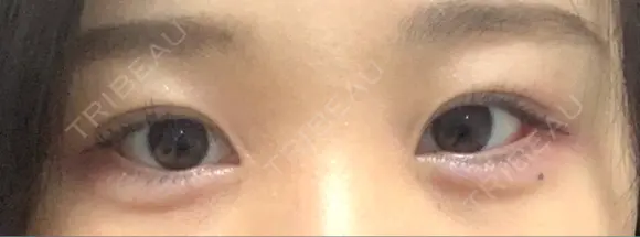 目尻切開 / タレ目形成・グラマラスライン（切開） / 目尻靭帯移動 アネシス美容クリニック AFTER メイン用