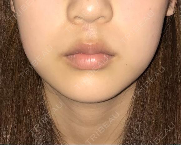 脂肪溶解注射（顔） 有楽町美容外科クリニック DAY 69 メイン用