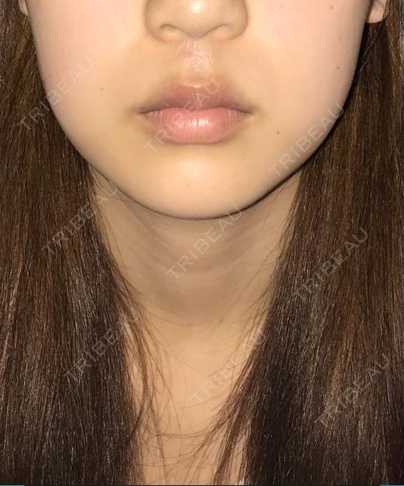 脂肪溶解注射（顔） 有楽町美容外科クリニック DAY 69 メイン用