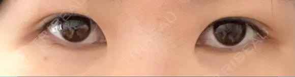 二重切開 松下皮フ形成外科 AFTER メイン用