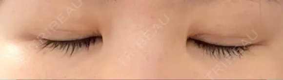 二重切開 松下皮フ形成外科 DAY 14 メイン用