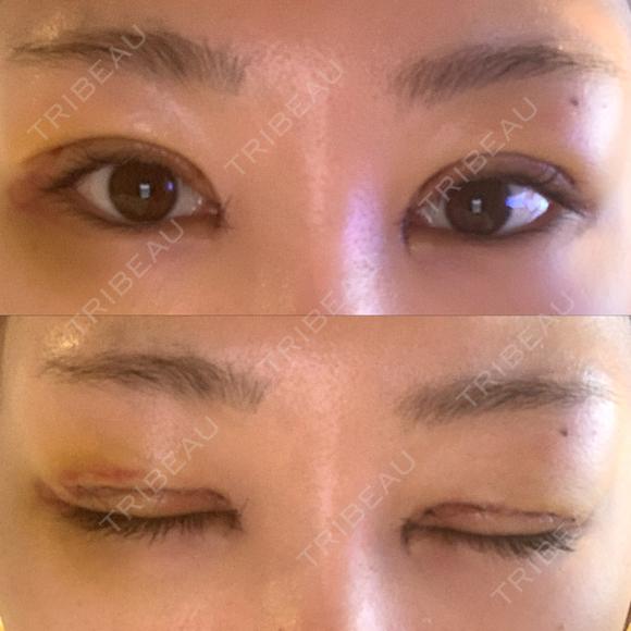 二重切開 / 目頭切開 / 眼瞼下垂（切開） / 脂肪吸引（顔） eクリニック 金沢本院 DAY 5 メイン用