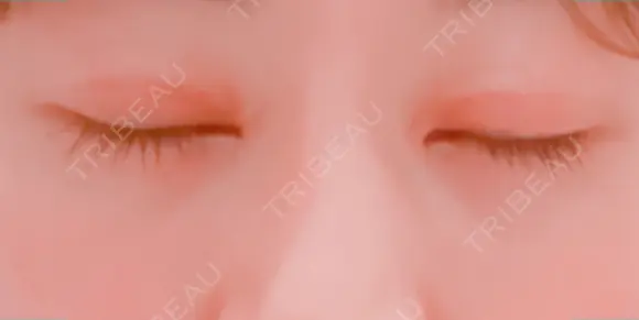二重切開 / 目頭切開 / 目尻切開 / 下まぶたの脂肪取り 湘南美容クリニック 新宿本院 DAY 31 メイン用
