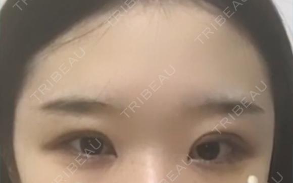 二重切開 / 目頭切開 / 眼瞼下垂（切開） / その他（目元） ブリスクリニック形成外科・美容外科・美容皮膚科 福岡 AFTER メイン用
