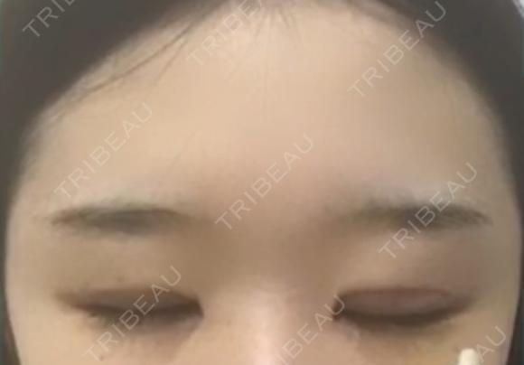 二重切開 / 目頭切開 / 眼瞼下垂（切開） / その他（目元） ブリスクリニック形成外科・美容外科・美容皮膚科 福岡 DAY 8 メイン用