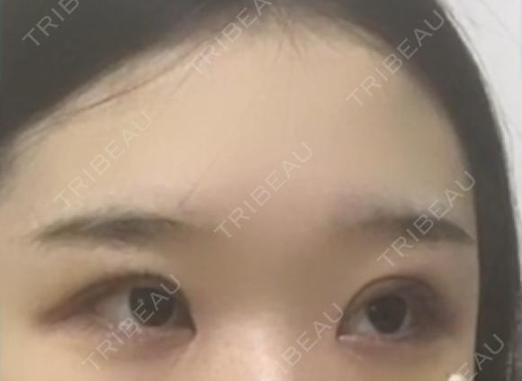 二重切開 / 目頭切開 / 眼瞼下垂（切開） / その他（目元） ブリスクリニック形成外科・美容外科・美容皮膚科 福岡 DAY 8 メイン用