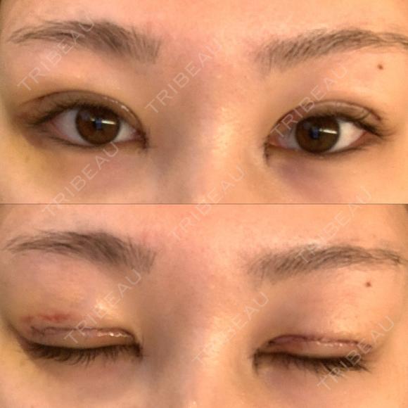 二重切開 / 目頭切開 / 眼瞼下垂（切開） / 脂肪吸引（顔） eクリニック 金沢本院 DAY 6 メイン用
