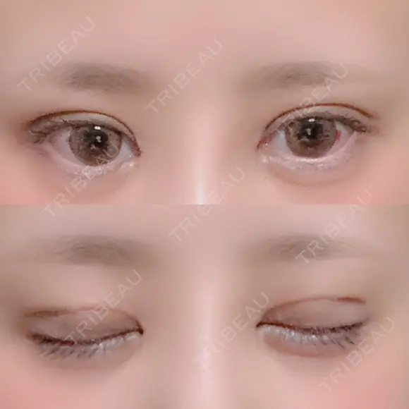 二重切開 / 目頭切開 / ヒアルロン酸注入（涙袋） FROM B整形外科 (旧バウム整形外科) DAY 11 メイン用