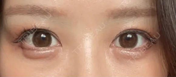 クマ治療 / 下まぶたたるみ取り / 下まぶたの脂肪取り APOLLO BEAUTY CLINIC DAY 6 メイン用
