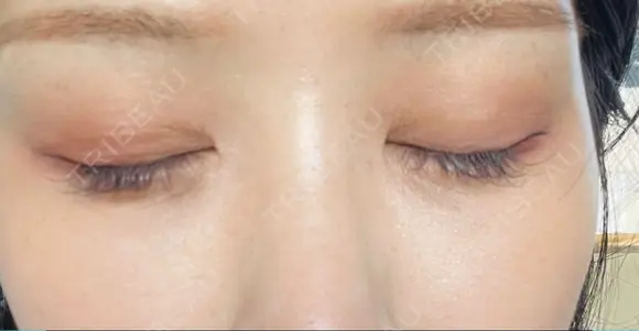 クマ治療 / 下まぶたたるみ取り / 下まぶたの脂肪取り APOLLO BEAUTY CLINIC DAY 12 メイン用