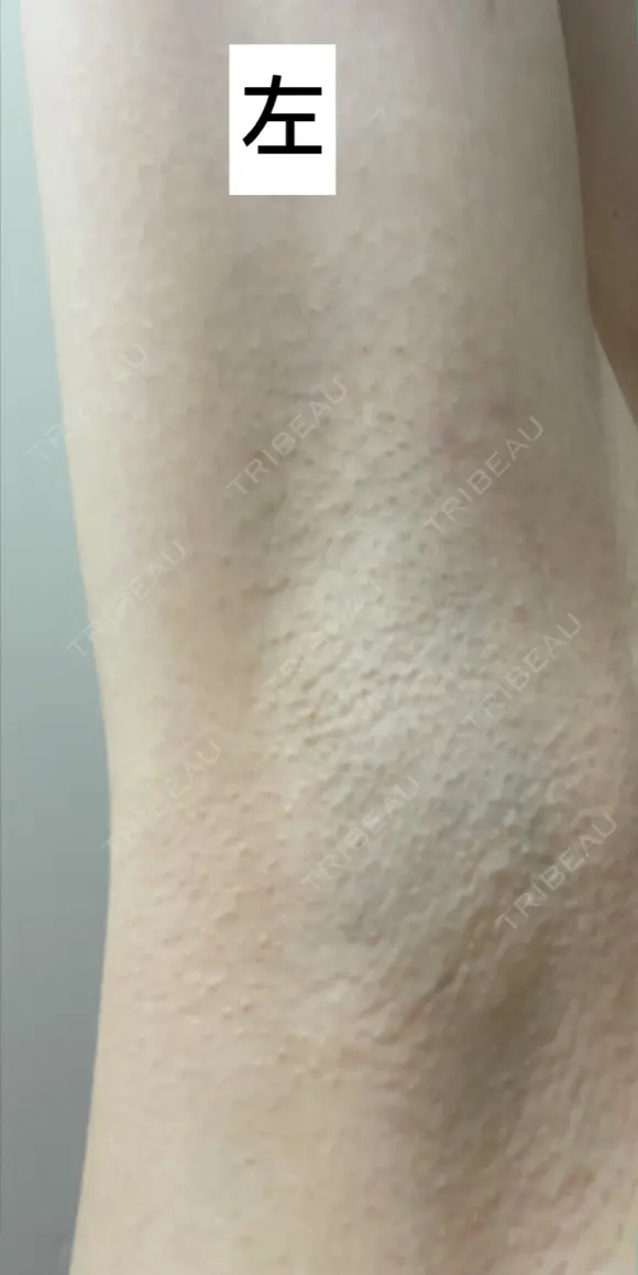ワキ汗治療（ボトックス） Mare beauty clinic DAY 8 メイン用