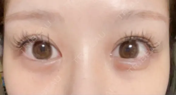 クマ治療 / 下まぶたたるみ取り / 下まぶたの脂肪取り APOLLO BEAUTY CLINIC AFTER メイン用