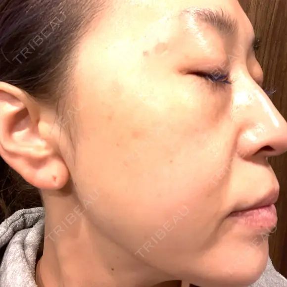 プラセンタ注射 / ピーリング（ニキビ・毛穴） / イオン導入 / シミ取りレーザー ナチュラルハーモニークリニック表参道 DAY 104 メイン用