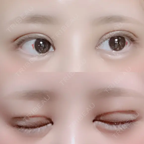 二重切開 / 目頭切開 / ヒアルロン酸注入（涙袋） FROM B整形外科 (旧バウム整形外科) DAY 12 メイン用