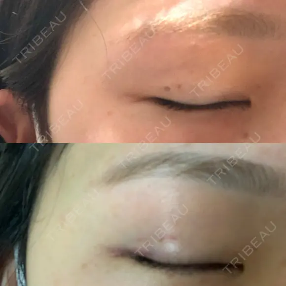 二重埋没 R.O.clinic DAY 381 メイン用