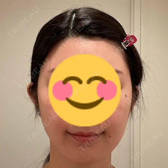 アートメイク（唇） LEAGRANT CLINIC 中目黒 DAY 4 メイン用