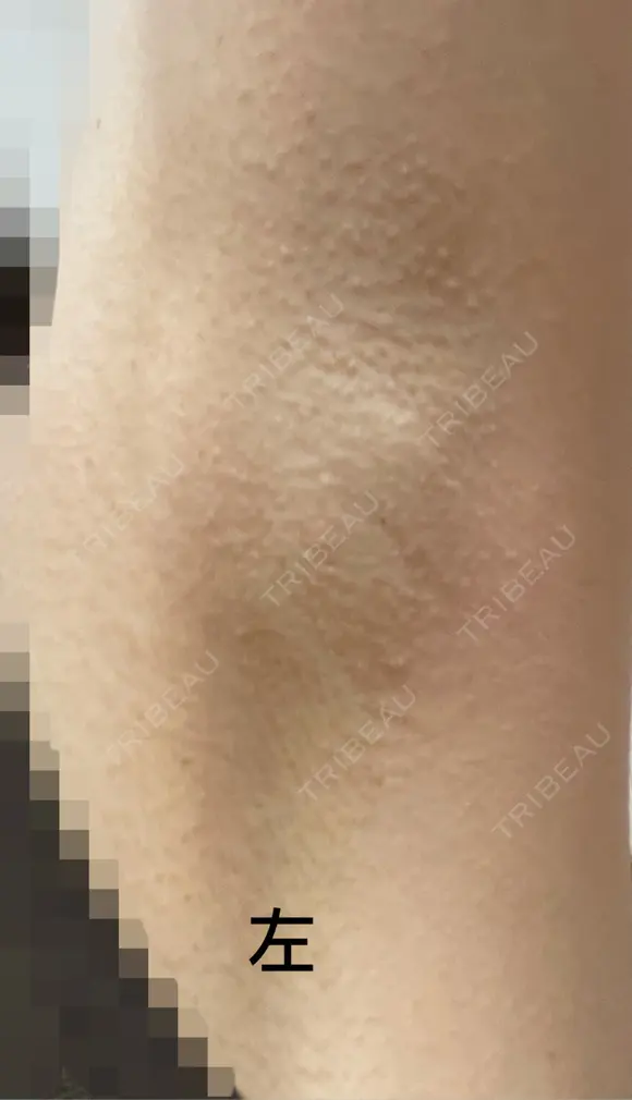 ワキ汗治療（ボトックス） Mare beauty clinic DAY 9 メイン用