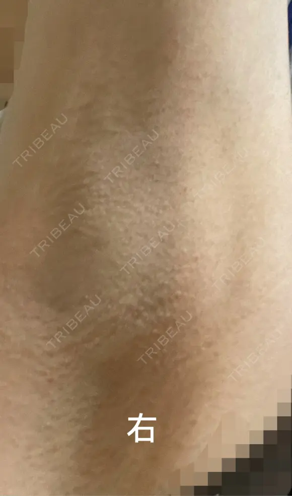 ワキ汗治療（ボトックス） Mare beauty clinic DAY 9 メイン用