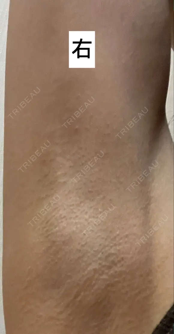 ワキ汗治療（ボトックス） Mare beauty clinic DAY 10 メイン用
