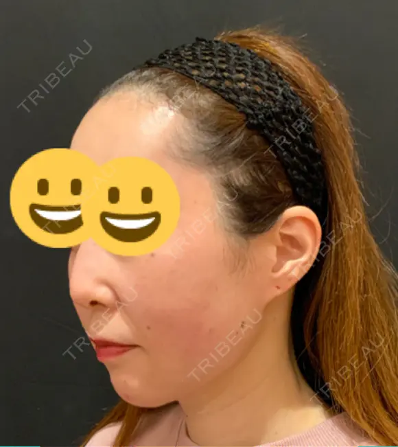 糸リフト / バッカルファット除去 / 脂肪吸引（顔） / ヒアルロン酸注入（鼻） / ヒアルロン酸注入（あご） 東京ミッドクリニック DAY 47 メイン用