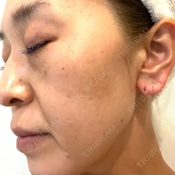 プラセンタ注射 / ピーリング（ニキビ・毛穴） / イオン導入 / シミ取りレーザー ナチュラルハーモニークリニック表参道 DAY 107 メイン用