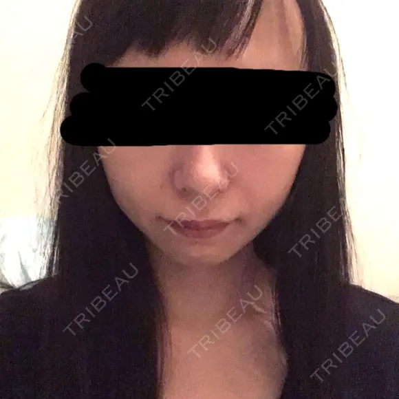 脂肪吸引（顔） / その他（輪郭） / 脂肪注入（輪郭） ヴィヴェンシアクリニック DAY 58 メイン用
