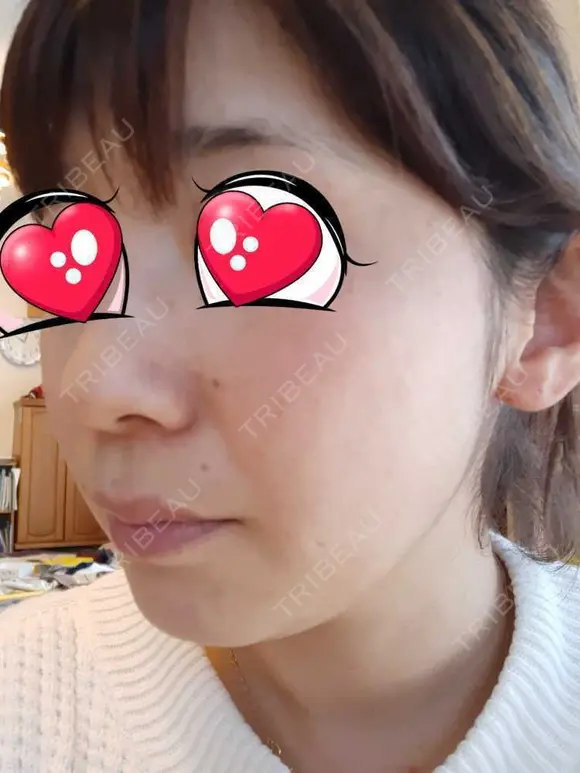光治療（フォトフェイシャルなど） BMC CLINIC 南青山 DAY 59 メイン用