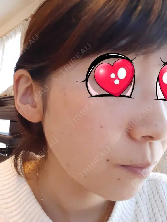 光治療（フォトフェイシャルなど） BMC CLINIC 南青山 DAY 59 メイン用