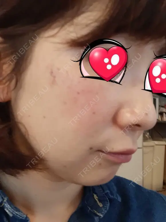 光治療（フォトフェイシャルなど） BMC CLINIC 南青山 DAY 49 メイン用