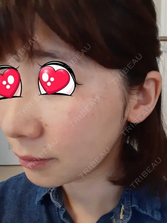 光治療（フォトフェイシャルなど） BMC CLINIC 南青山 DAY 49 メイン用