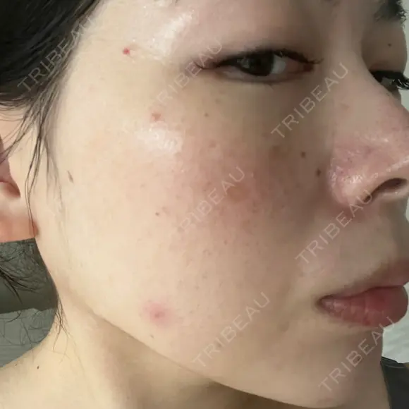 光治療（フォトフェイシャルなど） LETICIA CLINIC（レティシア クリニック） DAY 1 メイン用