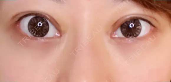 二重切開 / 目頭切開 / 目尻切開 / 下まぶたの脂肪取り 湘南美容クリニック 新宿本院 DAY 41 メイン用