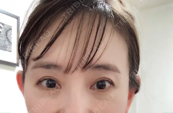 二重切開 / 眼瞼下垂（切開） 芦屋美容クリニック 芦屋院 DAY 79 メイン用