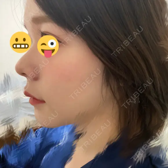 セットバック 大塚美容形成外科・歯科 大塚本院 DAY 84 メイン用