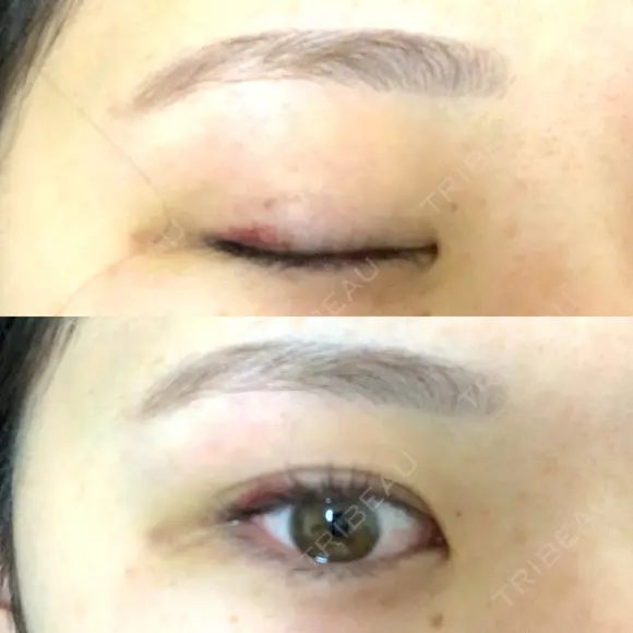 二重埋没 R.O.clinic DAY 391 メイン用