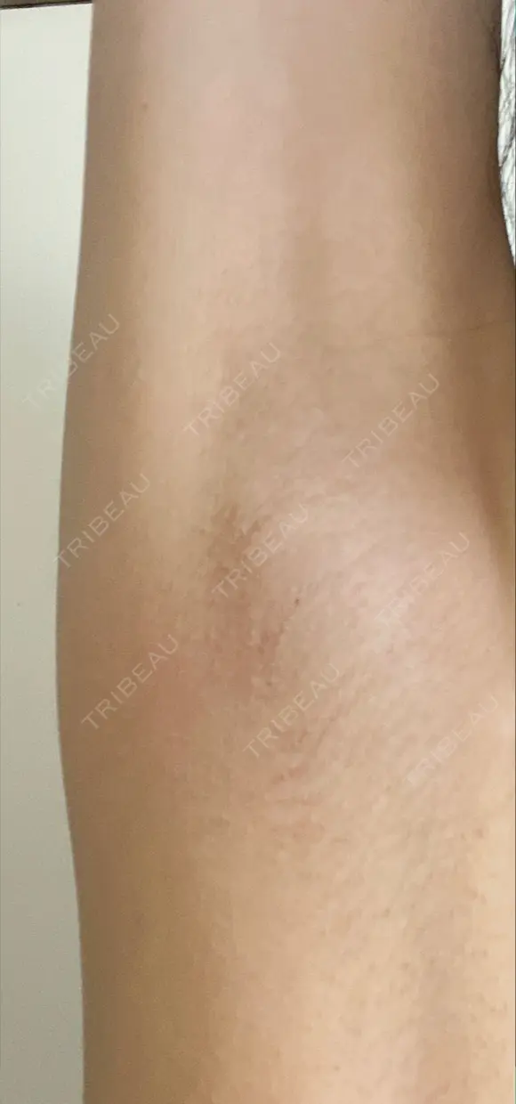 ワキ汗治療（ボトックス） Mare beauty clinic AFTER メイン用