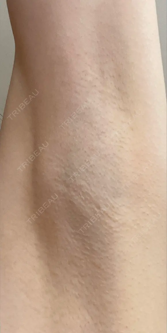 ワキ汗治療（ボトックス） Mare beauty clinic DAY 20 メイン用