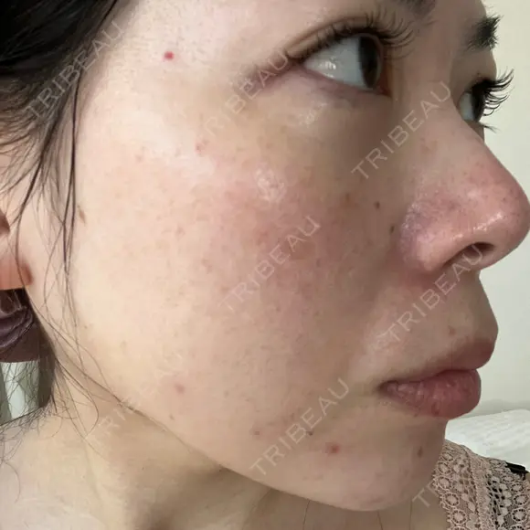 光治療（フォトフェイシャルなど） LETICIA CLINIC（レティシア クリニック） AFTER メイン用