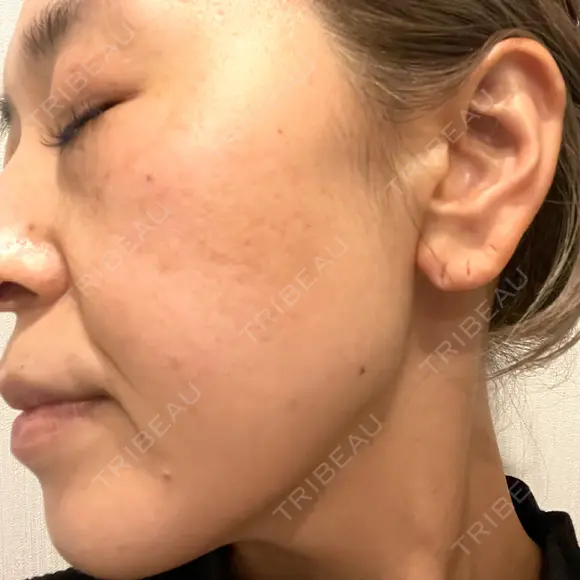 プラセンタ注射 / ピーリング（ニキビ・毛穴） / イオン導入 / シミ取りレーザー ナチュラルハーモニークリニック表参道 DAY 118 メイン用