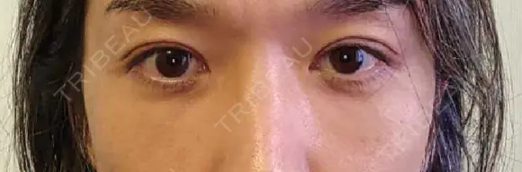 クマ治療 / 下まぶたたるみ取り / 下まぶたの脂肪取り セオリークリニック DAY 62 メイン用