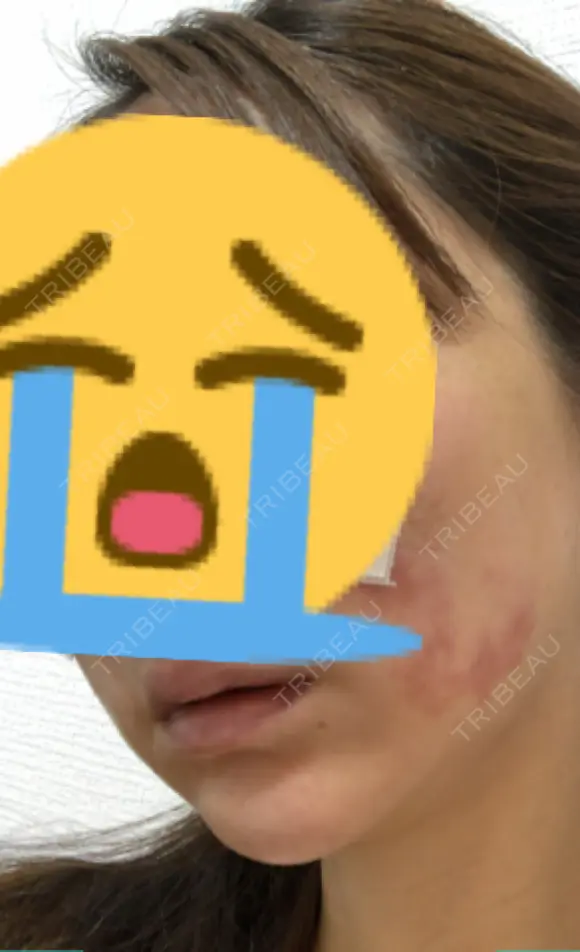 糸リフト / 水光注射（ハリ・美肌） / ヒアルロン酸注入（あご） / ハイフ（顔） 品川スキンクリニック表参道院 DAY 8 メイン用