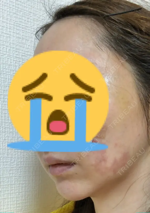 糸リフト / 水光注射（ハリ・美肌） / ヒアルロン酸注入（あご） / ハイフ（顔） 品川スキンクリニック表参道院 DAY 9 メイン用