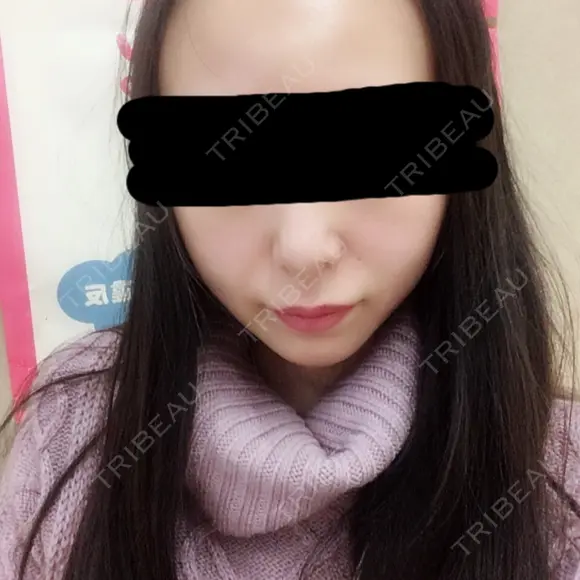 脂肪吸引（顔） / その他（輪郭） / 脂肪注入（輪郭） ヴィヴェンシアクリニック DAY 60 メイン用