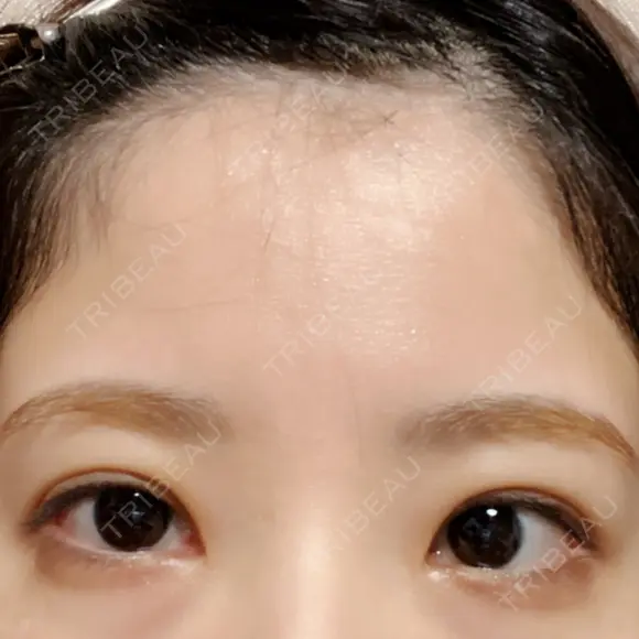 二重切開 こまちクリニック DAY 27 メイン用