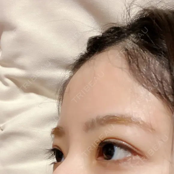 二重切開 こまちクリニック DAY 27 メイン用