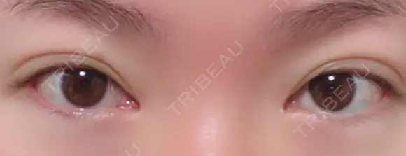 二重切開 / 目頭切開 / 上まぶたの脂肪取り 樹のひかり 形成外科・皮ふ科 DAY 231 メイン用