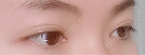 二重切開 / 目頭切開 / 上まぶたの脂肪取り 樹のひかり 形成外科・皮ふ科 DAY 231 メイン用